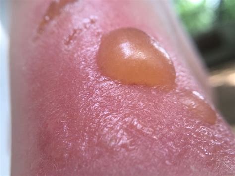 sunburn weeping|Sunburn blisters: Symptoms, diagnosis, and treatment。